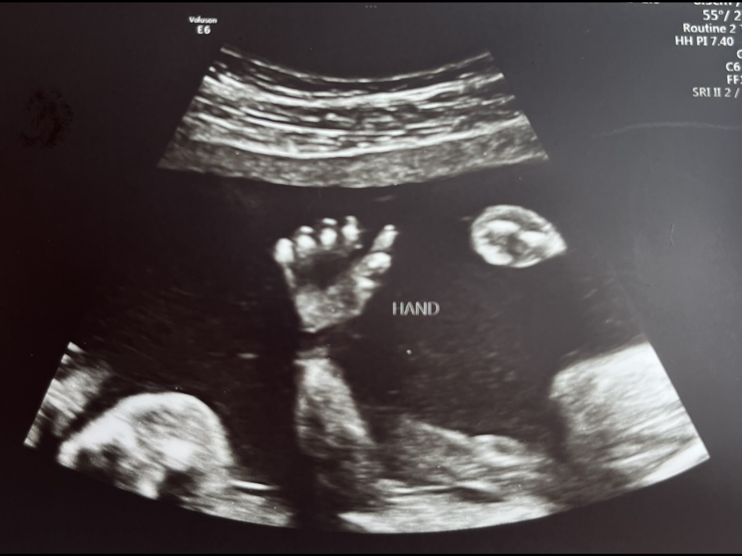 Ultrasound of baby’s hand