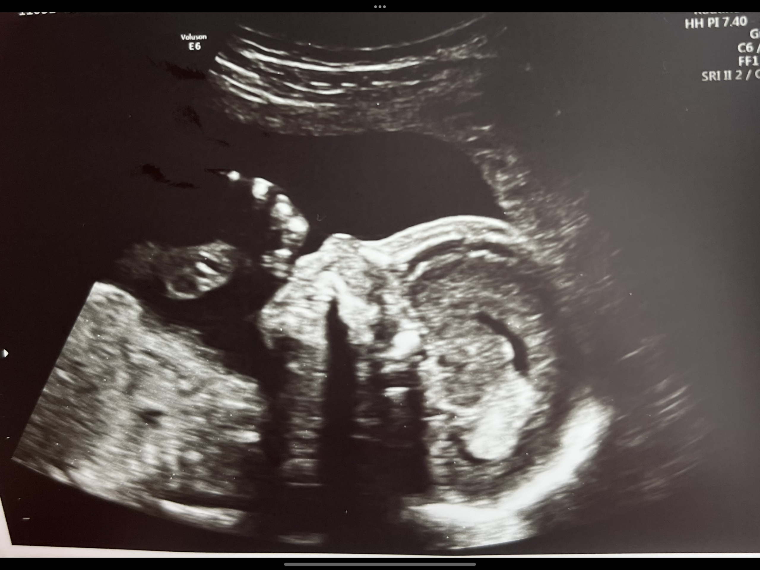 Ultrasound of side profile of baby